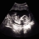 Prolife Approach to Challenging Prenatal Diagnoses